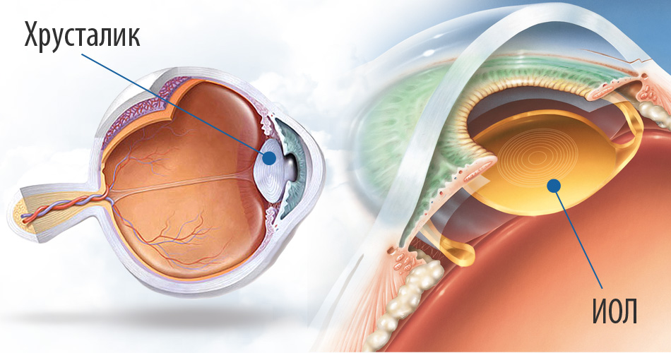 Американские алкон для глаза. Катаракта схема глаза. Анатомия хрусталика офтальмология. Искусственный хрусталик.