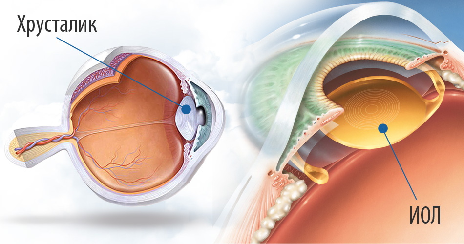 Хрусталик глаза. Катаракта схема глаза. Искусственный хрусталик. Имплантация торической ИОЛ. Хрусталик для глаза американский.