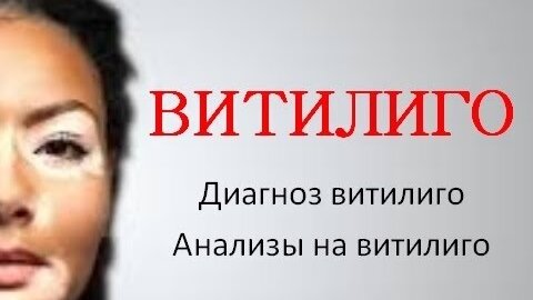 Витилиго. Диагностика. Анализы на витилиго.