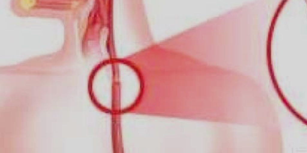 Измененный пищевод.