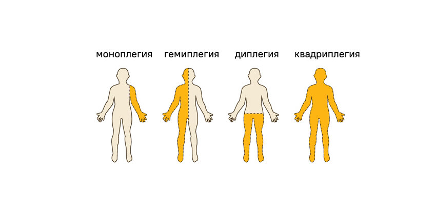 Можно ли вылечить ДЦП, если очень стараться? | Такие дела Такие дела