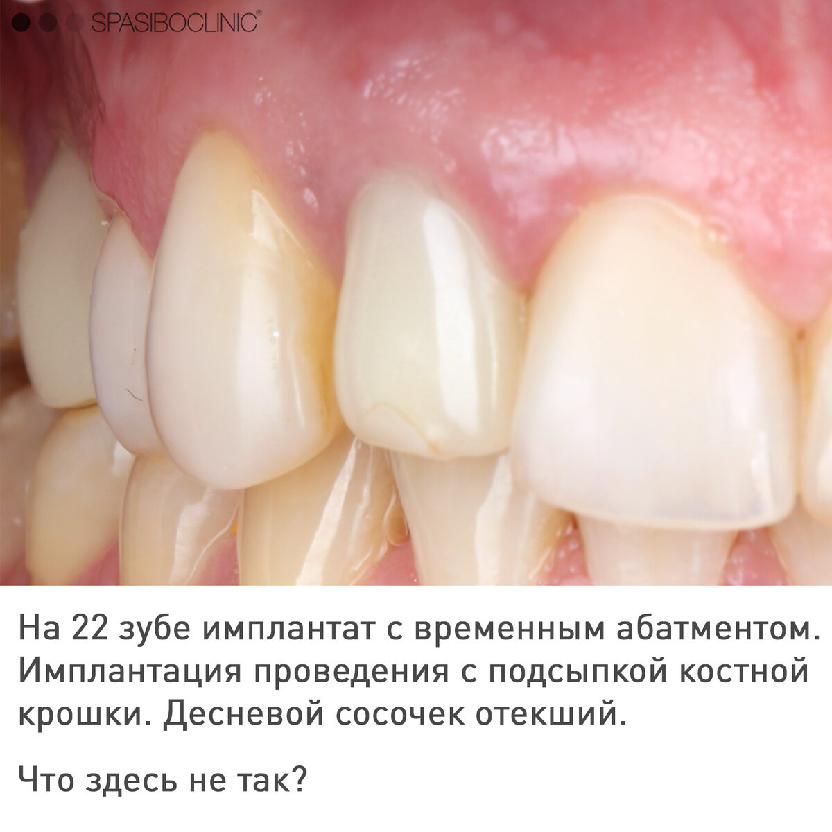 ОШИБКИ ИМПЛАНТАЦИИ | Спасибо.Клиник | Дзен