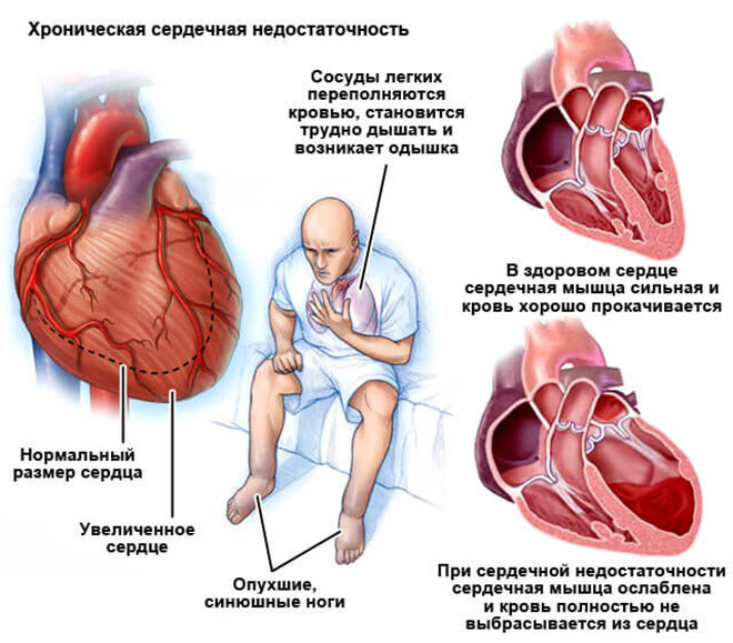 «Бычье сердце». Чем грозит человеку кардиомегалия?