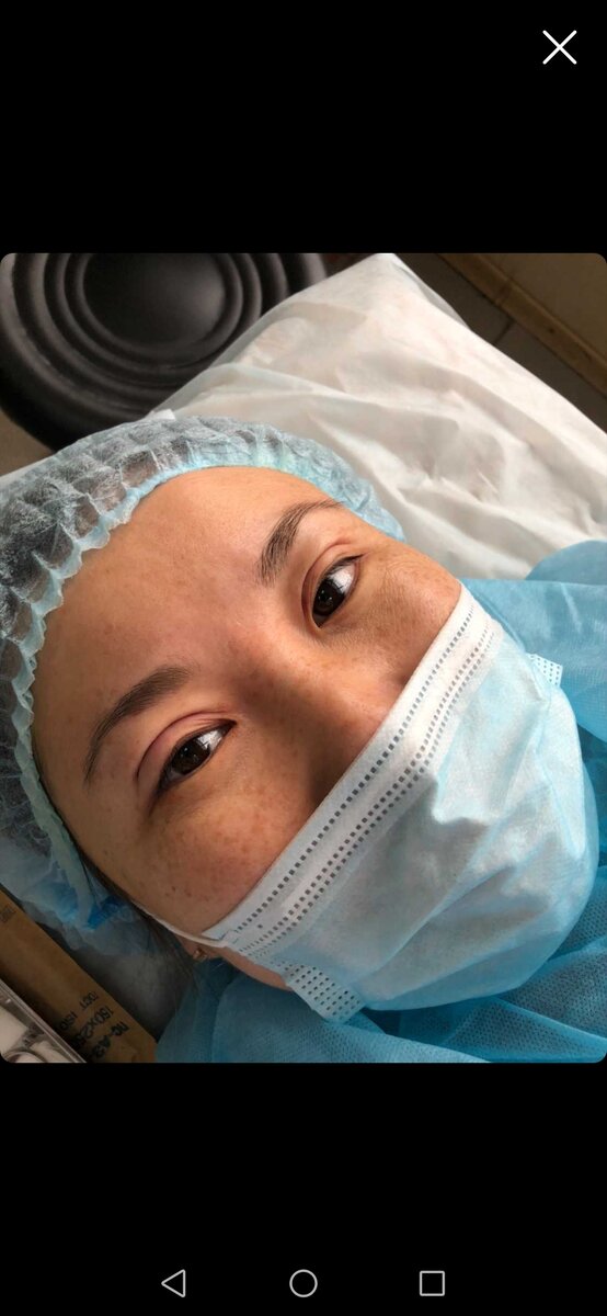 Фото из личного архива. Сразу после процедуры. 