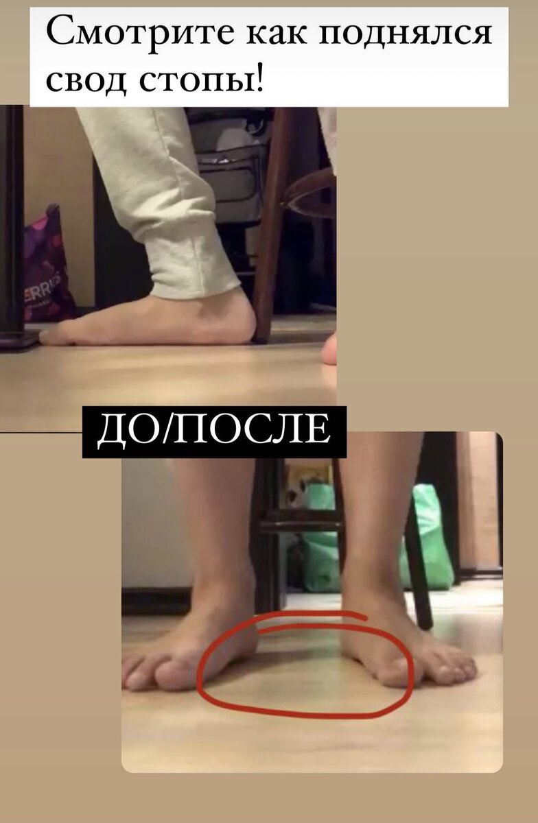 Результат работы над плоскостопием за месяц