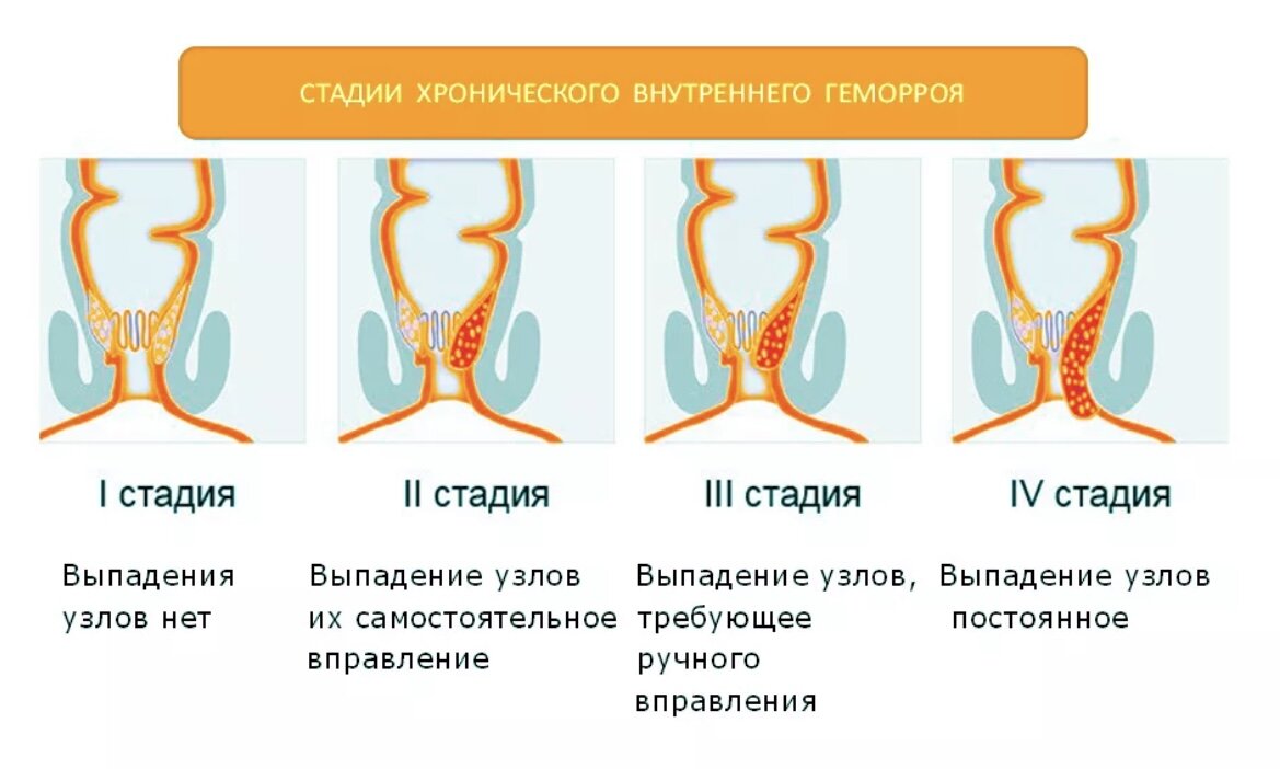 2 1 стадий. Выпадение узлов геморроя 2 степени. Степень геморроя выпадения узлов. Хронический внутренний геморрой стадии. Стадии наружного геморроя схема.