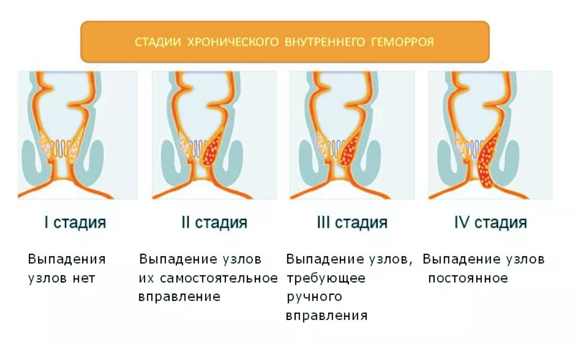 Внутренний узел. Выпадение узлов геморроя 2 степени. Степень геморроя выпадения узлов. Хронический внутренний геморрой стадии. Стадии наружного геморроя схема.