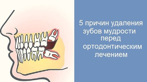 Пять причин для удаления зубов мудрости перед ортодонтическим лечением.