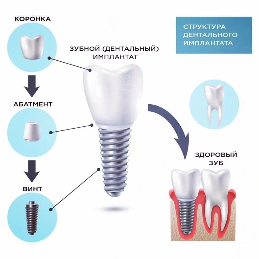 Схема импланта зуба