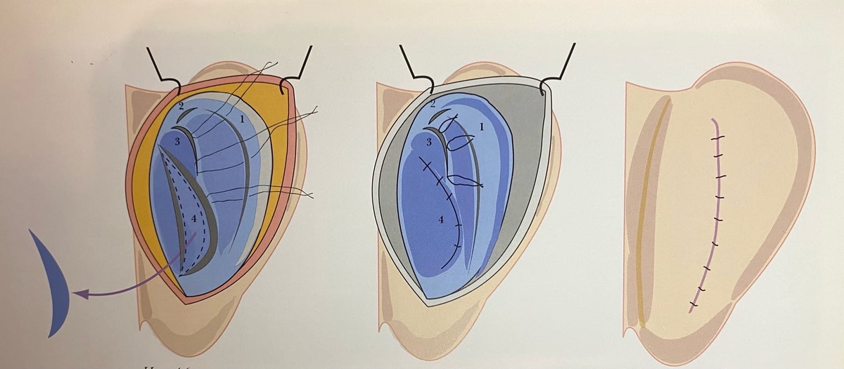 Коррекция ушной раковины.