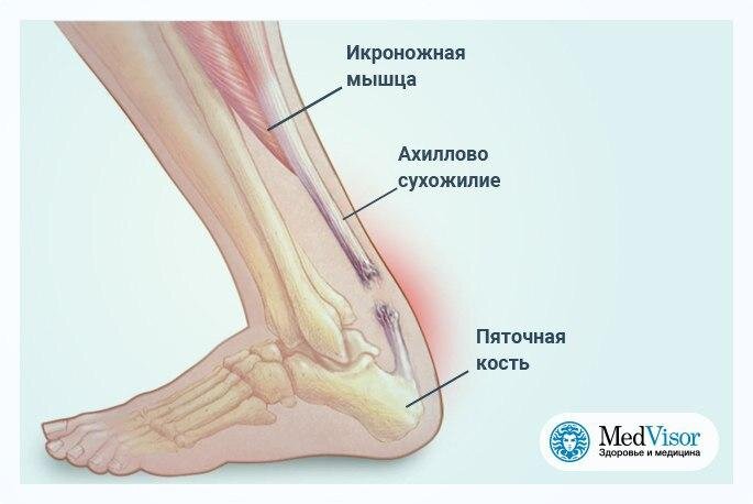 Сухожилия икроножной мышцы анатомия