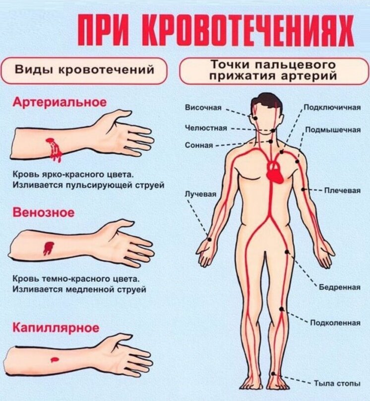 Как выглядит кровотечение фото Медицина ч1 - остановка кровотечения при БП Готовы? Дзен