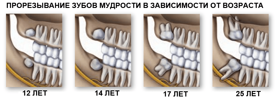 Зуб мудрости фото какой по счету