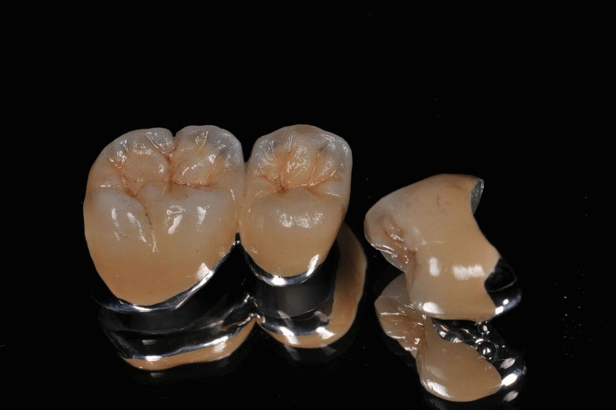 Металлокерамические коронки на каркасе из кобальт-хромового сплава. Металл керамика коронка. Скол керамической коронки. Металлокерамическая коронка фарфоровая. Безметалловая керамика диоксид циркония.