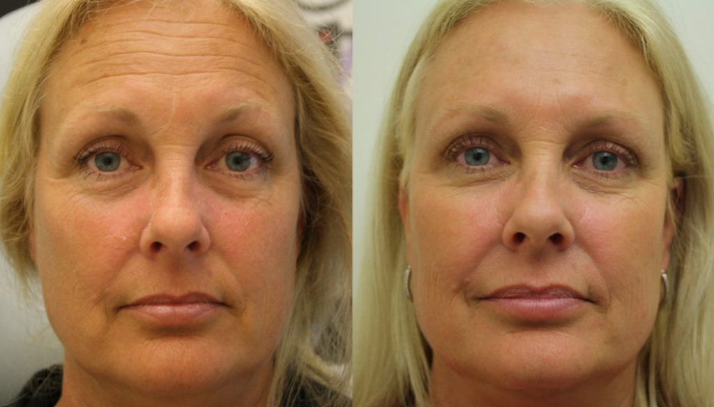 Межбровная морщина до и после. Убрать морщины инъекции. Ботокс для лица до и после. Филеры в косметологии. Ботокс для лица.