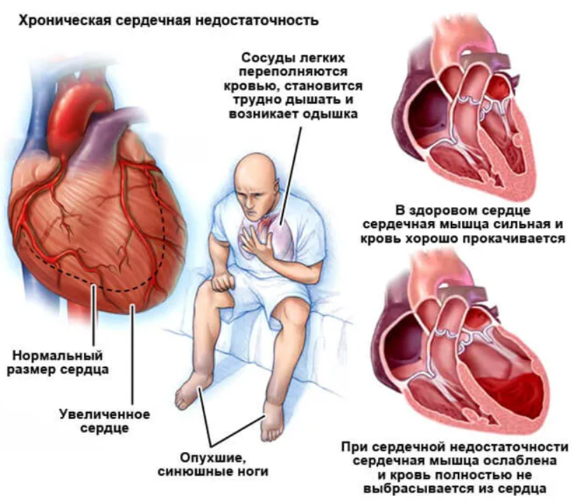 Насколько сердце. ХСН хроническая сердечная недостаточность симптомы. Симптомы хронической сердечной недостаточности. Сердечная недостаточно. Серлечнаянедостаточность.