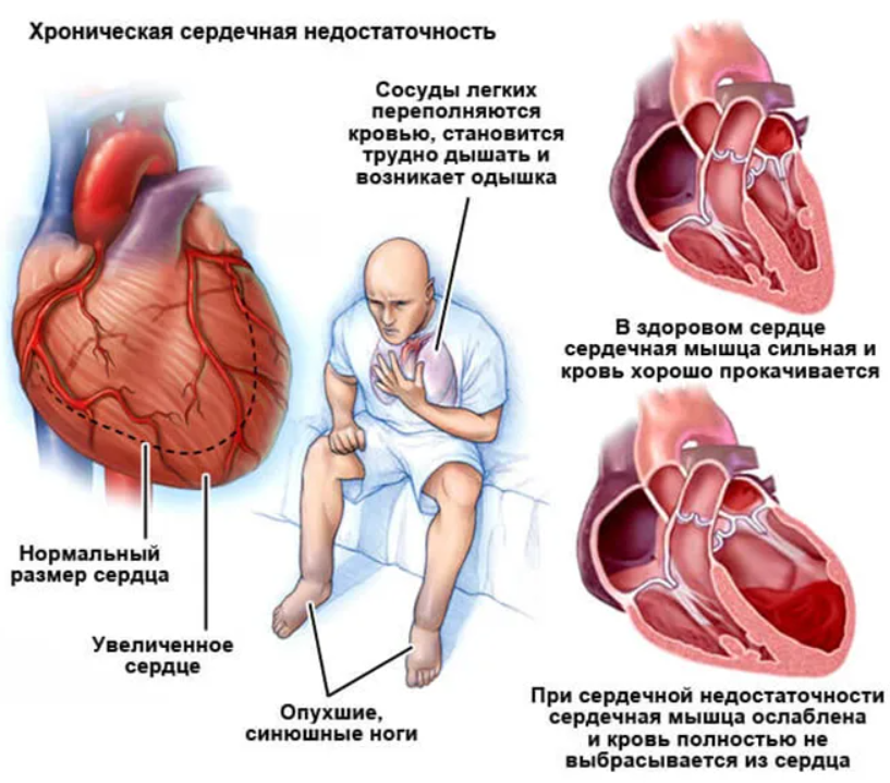 сердечная недостаточность