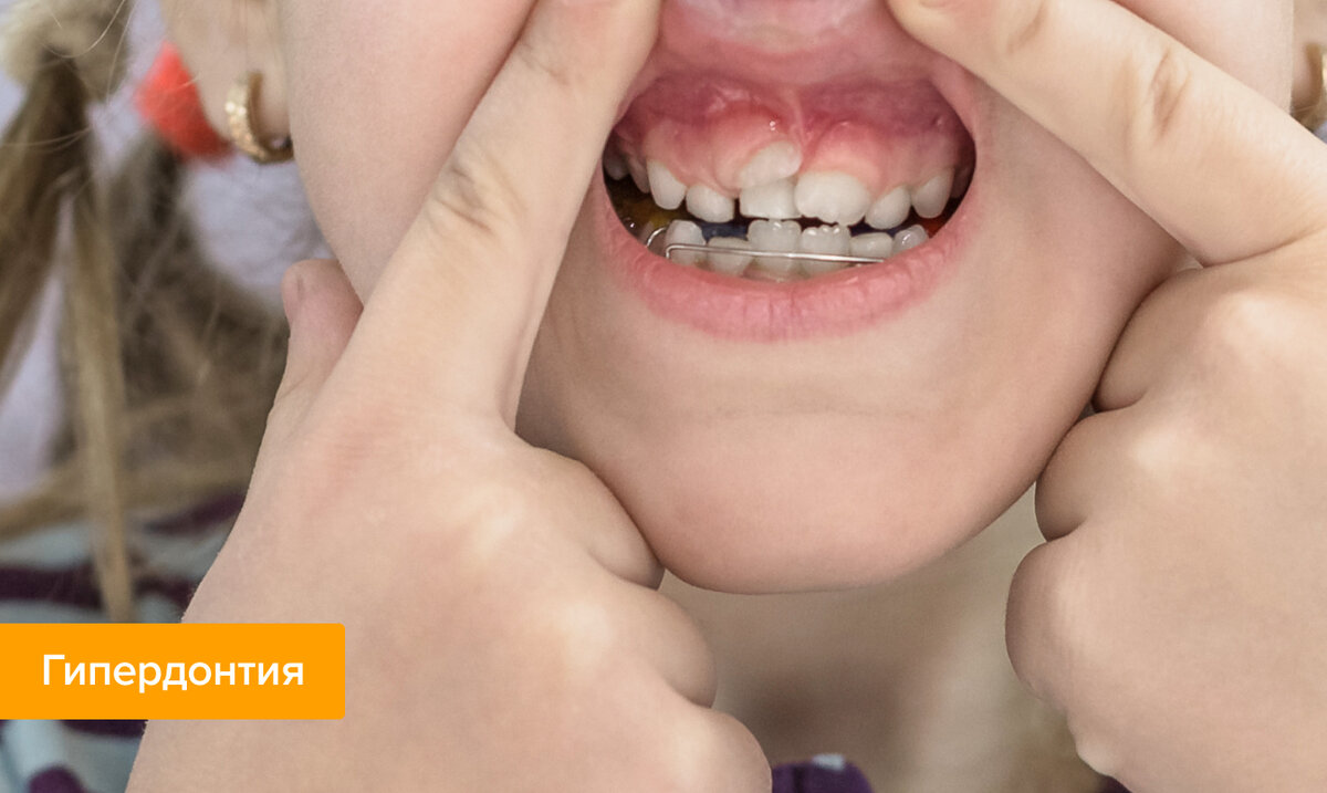 ТОП-15 самых частых болезней зубов | Журнал Startsmile о стоматологии ...