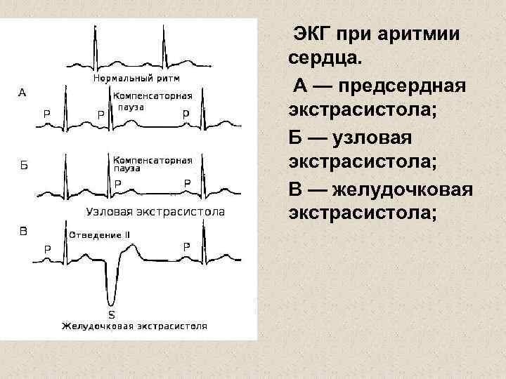 Аритмия на экг фото