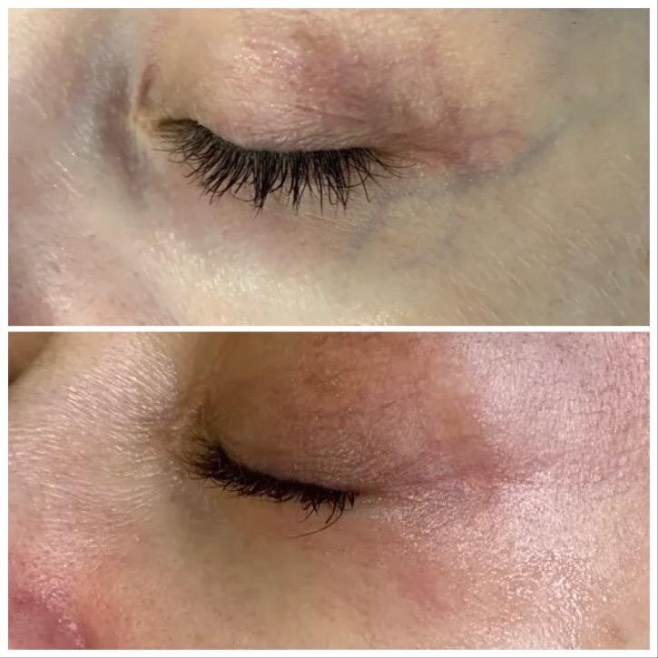 Лазерное удаление сосудов до после