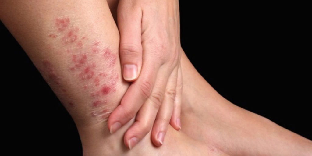 Образование пятен, пузырей в месте расчеса.