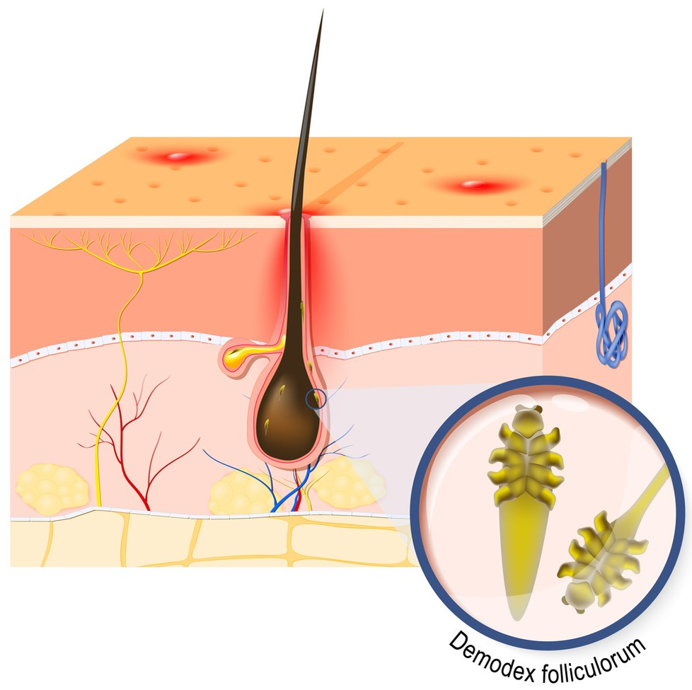 Демодекоз схема. Demodex folliculorum заболевание.