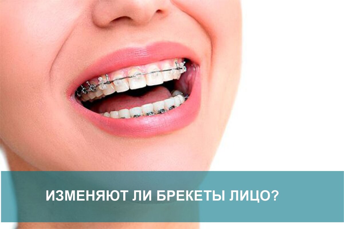 Как снять брекеты в домашних условиях как снимать брекеты дома (100) фото