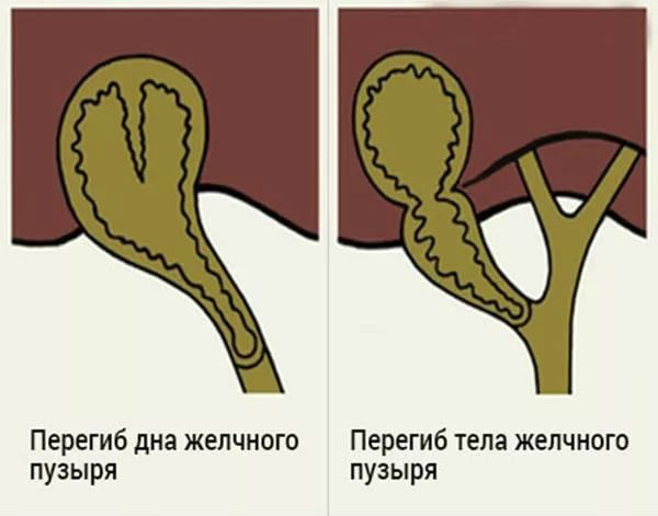 Загиб желчного пузыря в области дна. Деформированный желчный пузырь с перегибом. Перекрут желчного пузыря. Перекрут и загиб желчного пузыря.