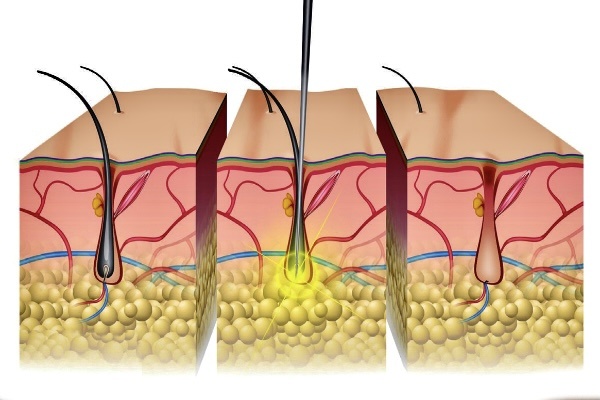 Для более полного представления, на данном рисунке показано, что после введения иглы (толщиной 0.1- 0.08 мм) подаётся электрический импульс и волосяной фолликул погибает.