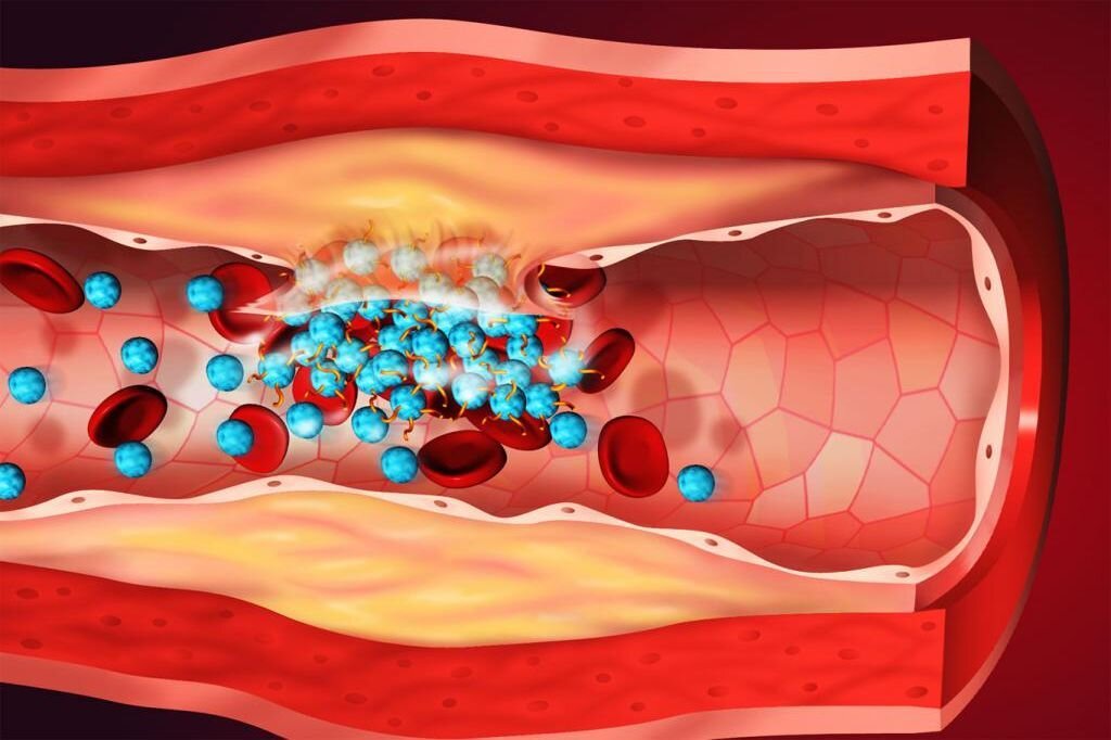 Тромб что это. Воспалительный процесс в артериях. Профилактика тромбов в сосудах.