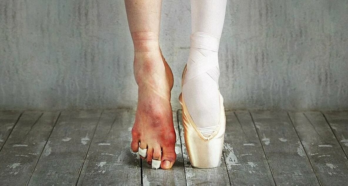 типичная стопа балерины