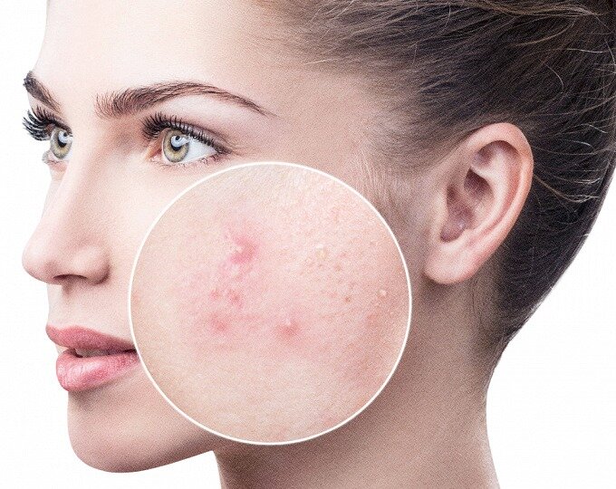 акне
источник:  clinicaspersona.com