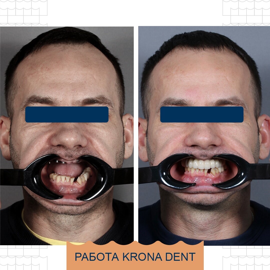 Варианты имплантации при полном отсутствии зубов