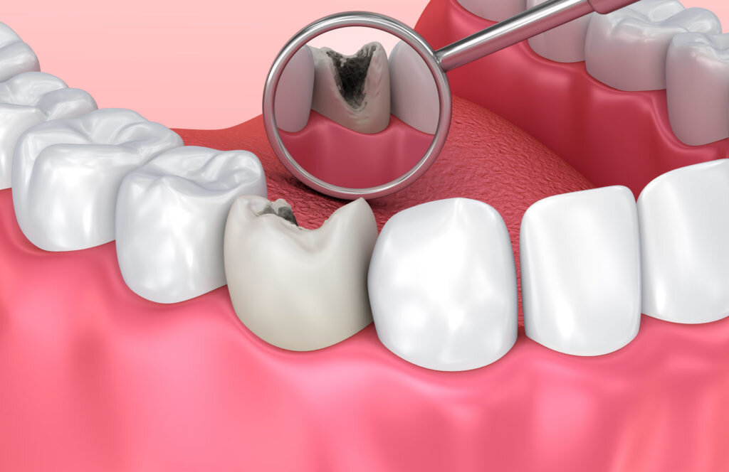 Часть зуба откололась в следствие развития кариеса