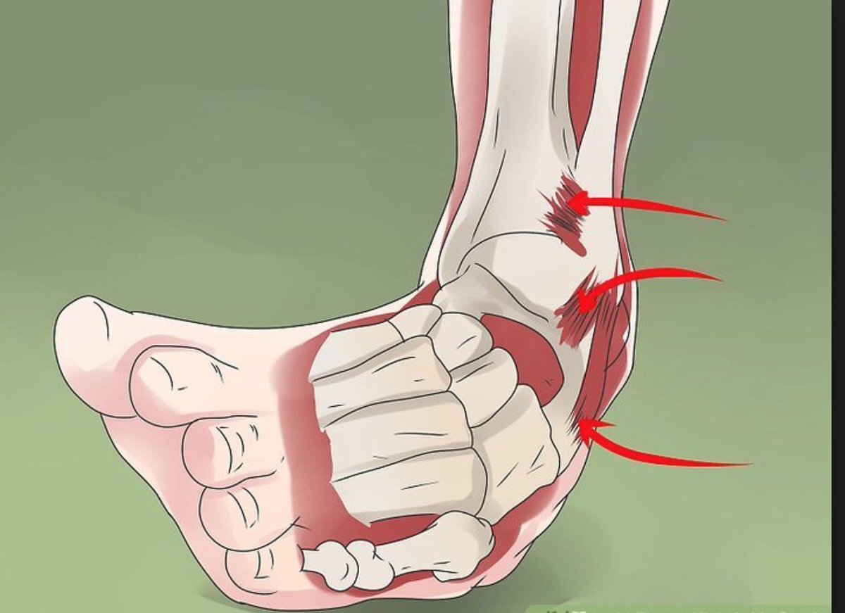 Перерастяжение связок голеностопа. Голеностопный сустав разорванные связки. Повреждение связок голеностопного сустава.