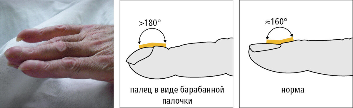 Ногти Гиппократа: стоит ли бояться такой деформации?