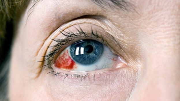 К основным причинам покраснения глаз и кровоизлияний относятся: