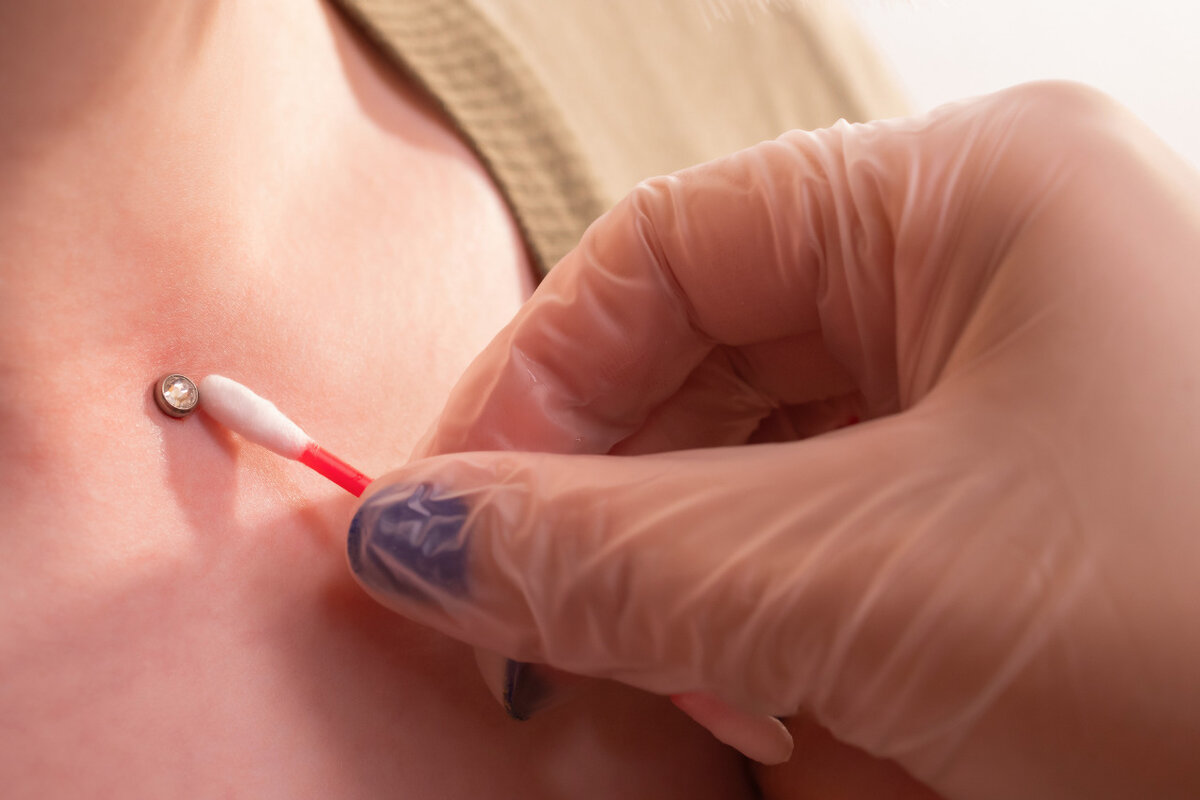 Микродермал ставят при помощи скальпеля в разрез шириной до 3 мм. Фото: depositphotos.com