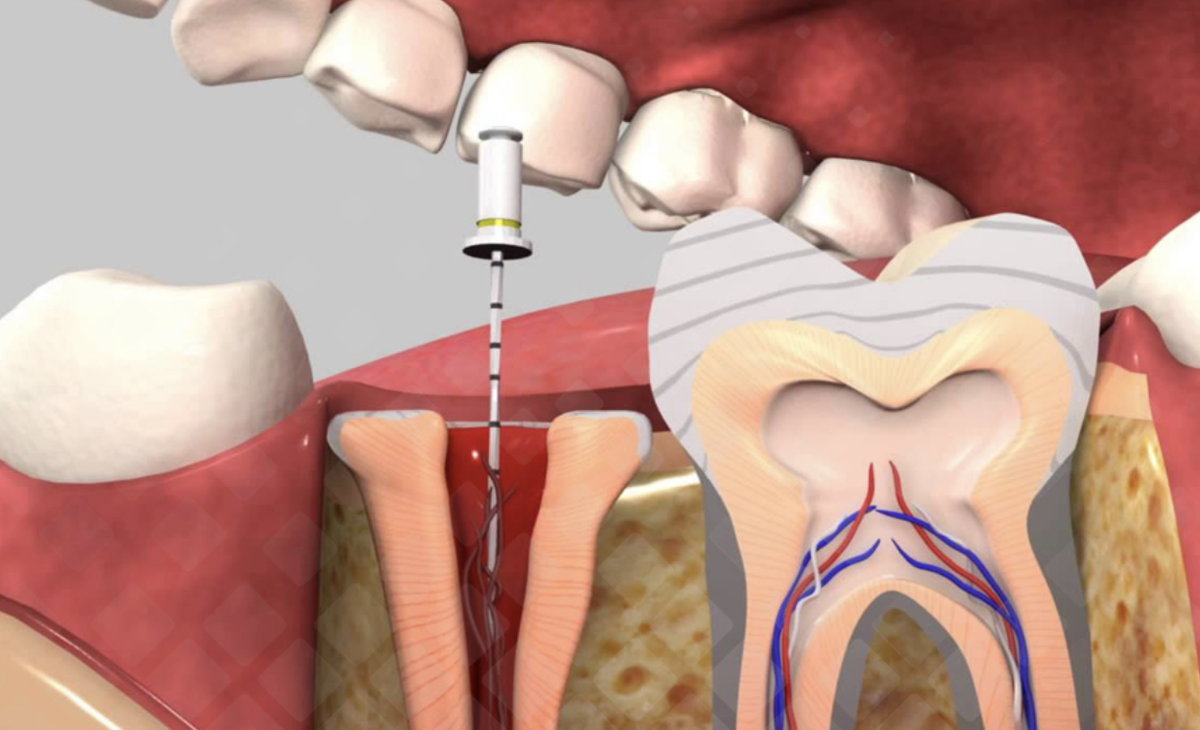 Root canal. Депульпирование однокорневого зуба. Депульпирование зуба (удаление нерва).
