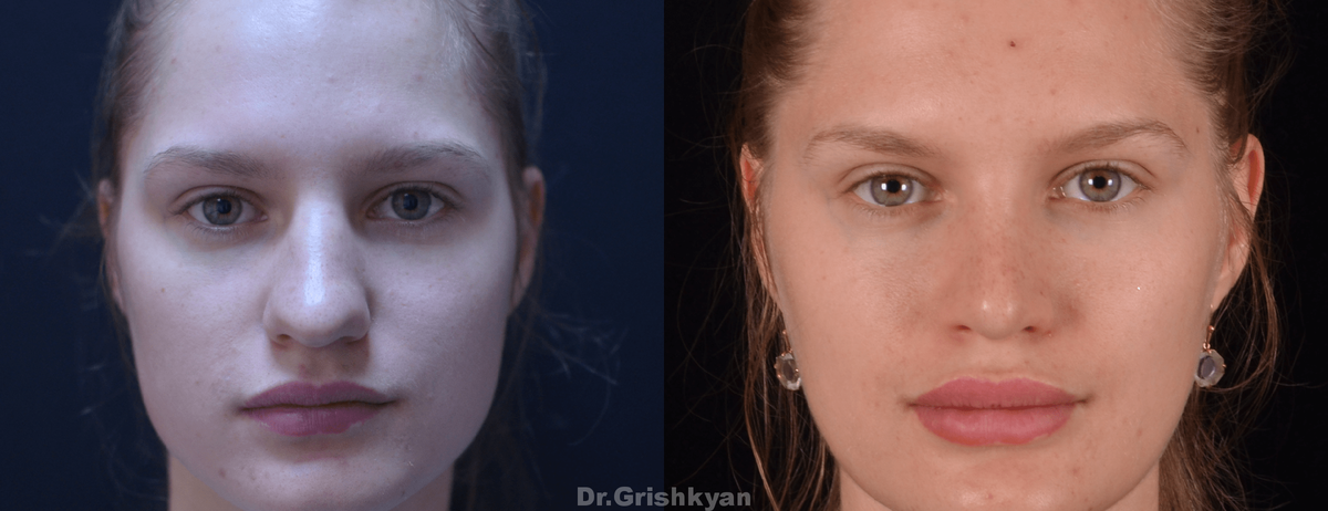 Ринопластика широкого носа фото до и после. Фото с сайта Д.Р. Гришкяна. Имеются противопоказания, требуется консультация специалиста