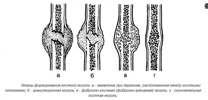 Этапы формирования костной мозоли. Фото из открытых источников 