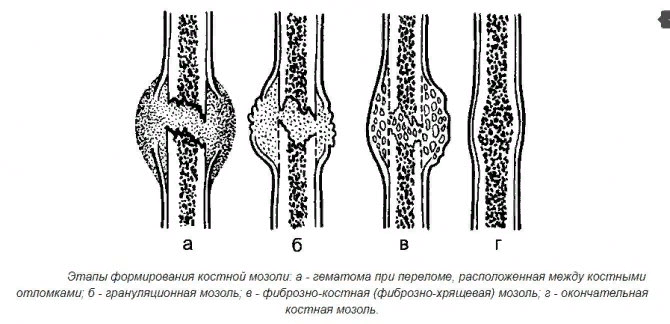 Костная мозоль после ринопластики