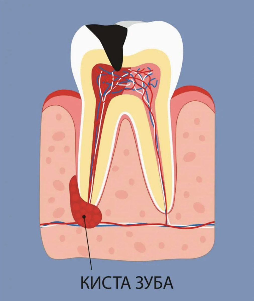 Методы избавления от зубной боли. Можно ли простудить зуб. Периодонтит десна воспалилась. Можно ли простудить зуб. Пульпа зуба анатомия зуба.