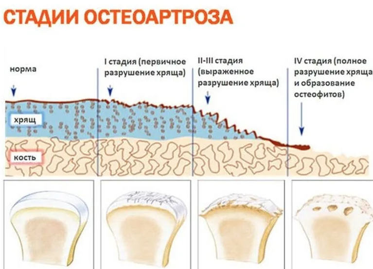 Артроз степени. Деформирующий остеоартроз первичный и вторичный. Степени деформирующего остеоартроза. Стадии развития остеоартроза. Стадии и степени остеоартроза