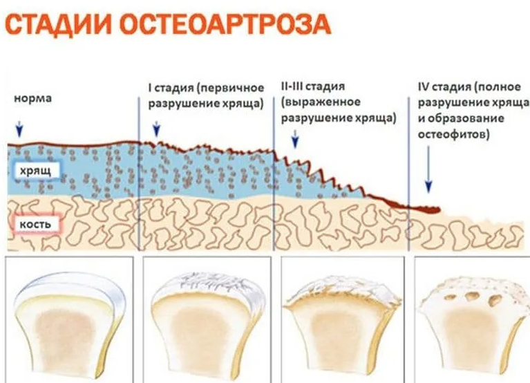 Артроз степени. Деформирующий остеоартроз первичный и вторичный. Степени деформирующего остеоартроза. Стадии развития остеоартроза. Стадии и степени остеоартроза.