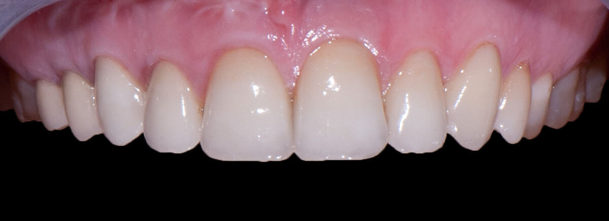 Что делать, если нет зачатков постоянных зубов, а молочные клыки так и ...