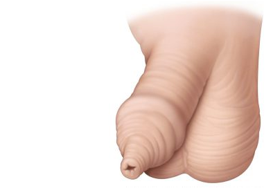 Фимоз. Изображение https://uroweb.org 