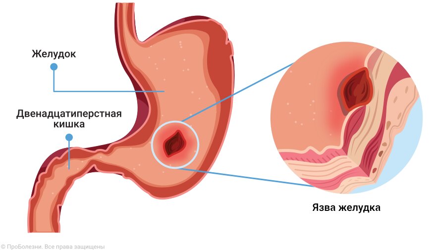 Язва желудка симптомы и лечение. Эрозия желудка симптомы.