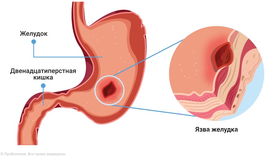 Лечение Стеноз привратника желудка в Чите, симптомы, причины, способы лечения | Эталон Мед