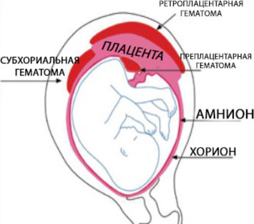 Лечение гематомы при беременности